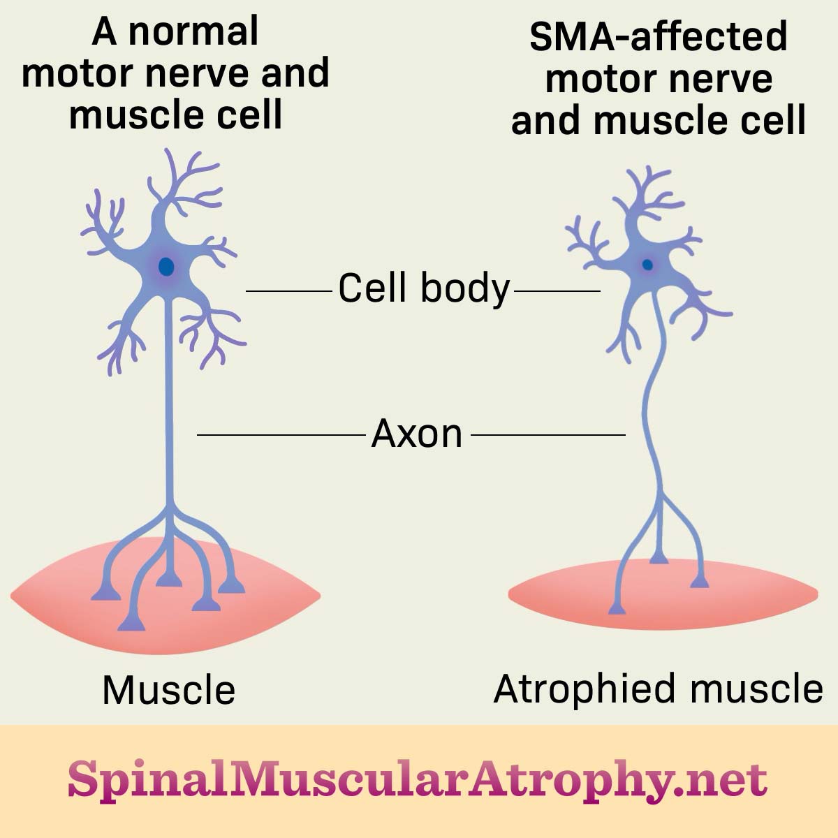 A normal “motor” nerve and muscle cell compared to an SMA-affected “motor” nerve and muscle cell and how this impacts the size of the muscle