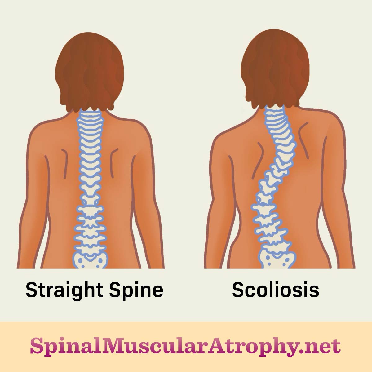 A straight spine on the back compared to a spine that is curved due to scoliosis. 